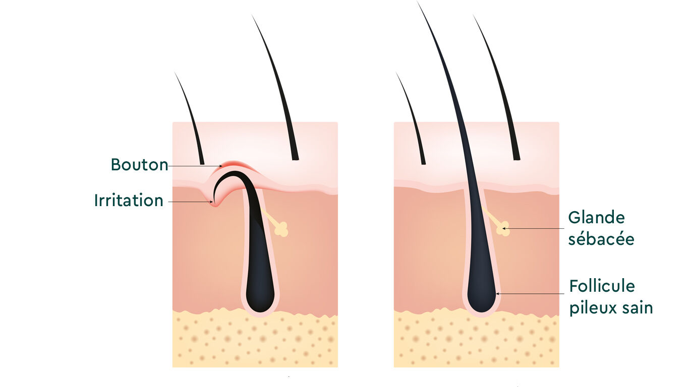 Illustration : comparaison entre une coupe transversale de la peau, un poil incarn&eacute; et un poil sain. 