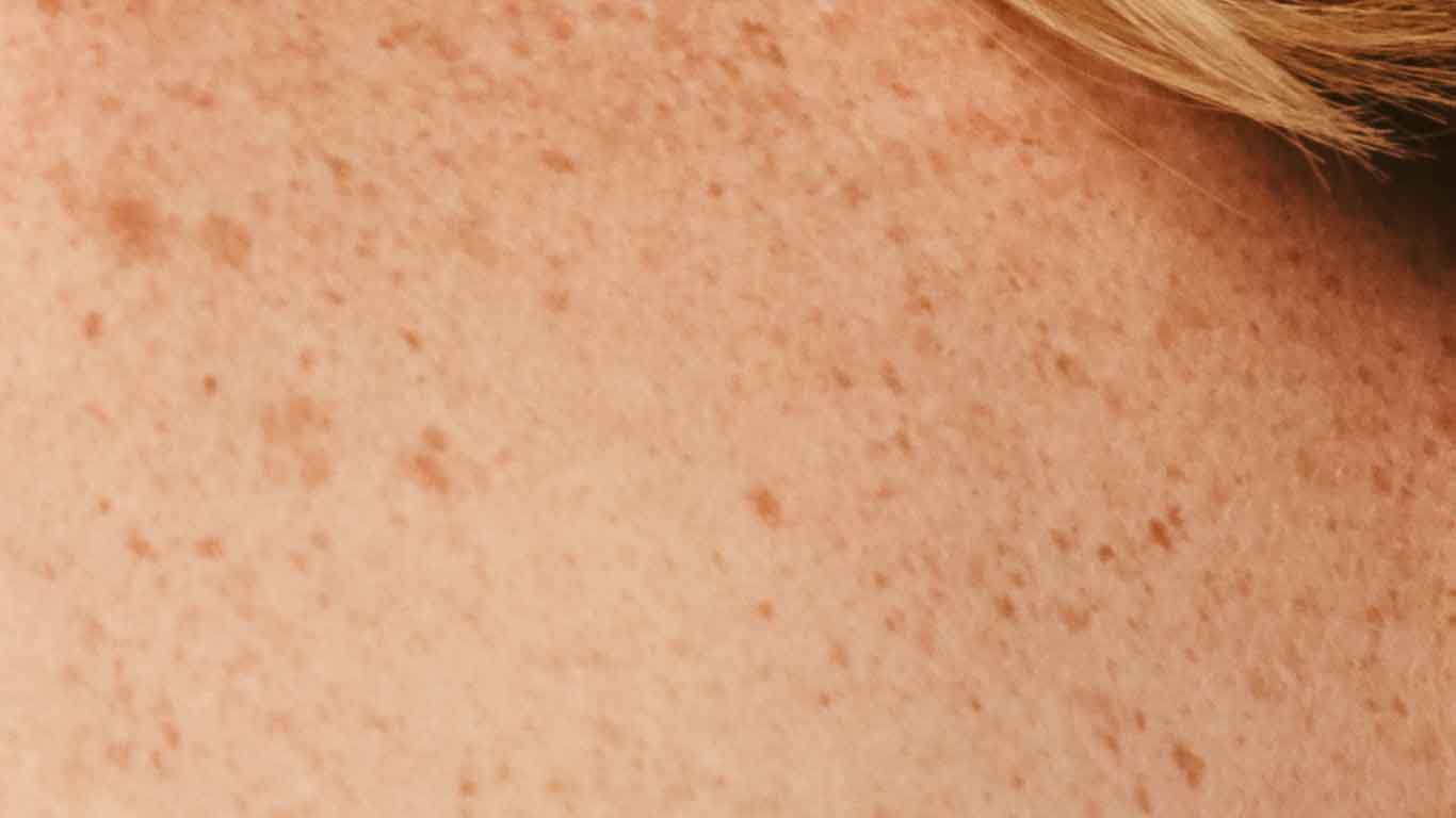 Gros plan sur une peau parsem&eacute;e de taches de rousseur. 