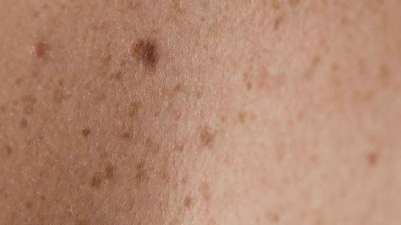 Gros plan sur une peau pr&eacute;sentant des taches de vieillesse. 
