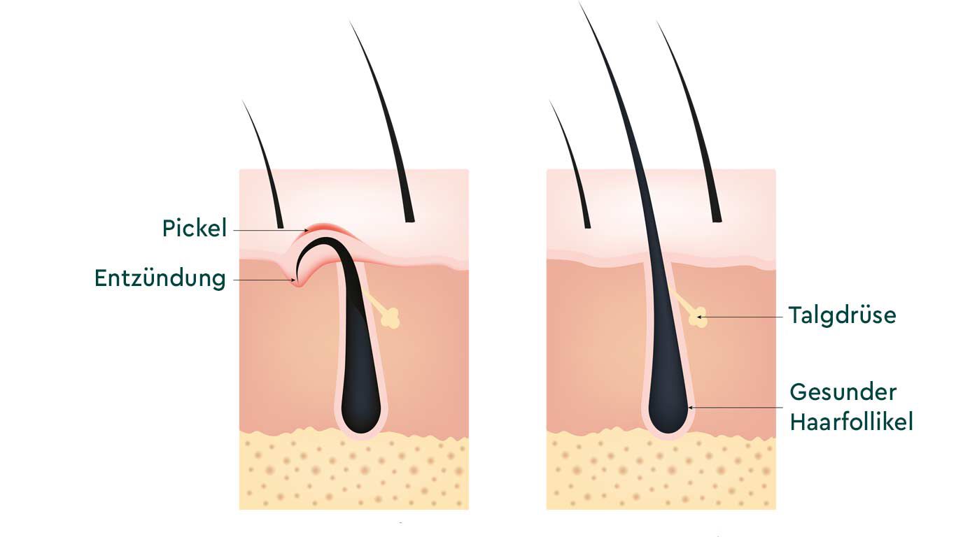 Illustration: Gegenüberstellung Querschnitt Haut, Eingewachsenes Haar versus Gesundes Haar. 