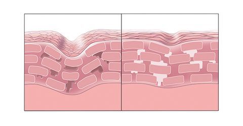 The skin barrier